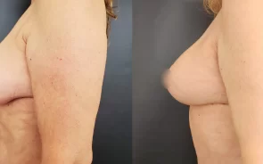 Antes y después de mastopexia