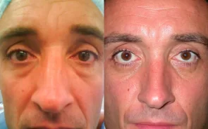 Blefaroplastia en hombre