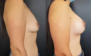 Resultado aumento de senos