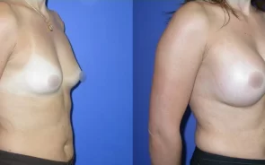 Resultado de mamoplastia de aumento