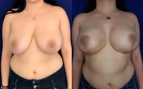 Resultado de mamoplastia de reducción