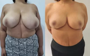 Resultado reducción de senos